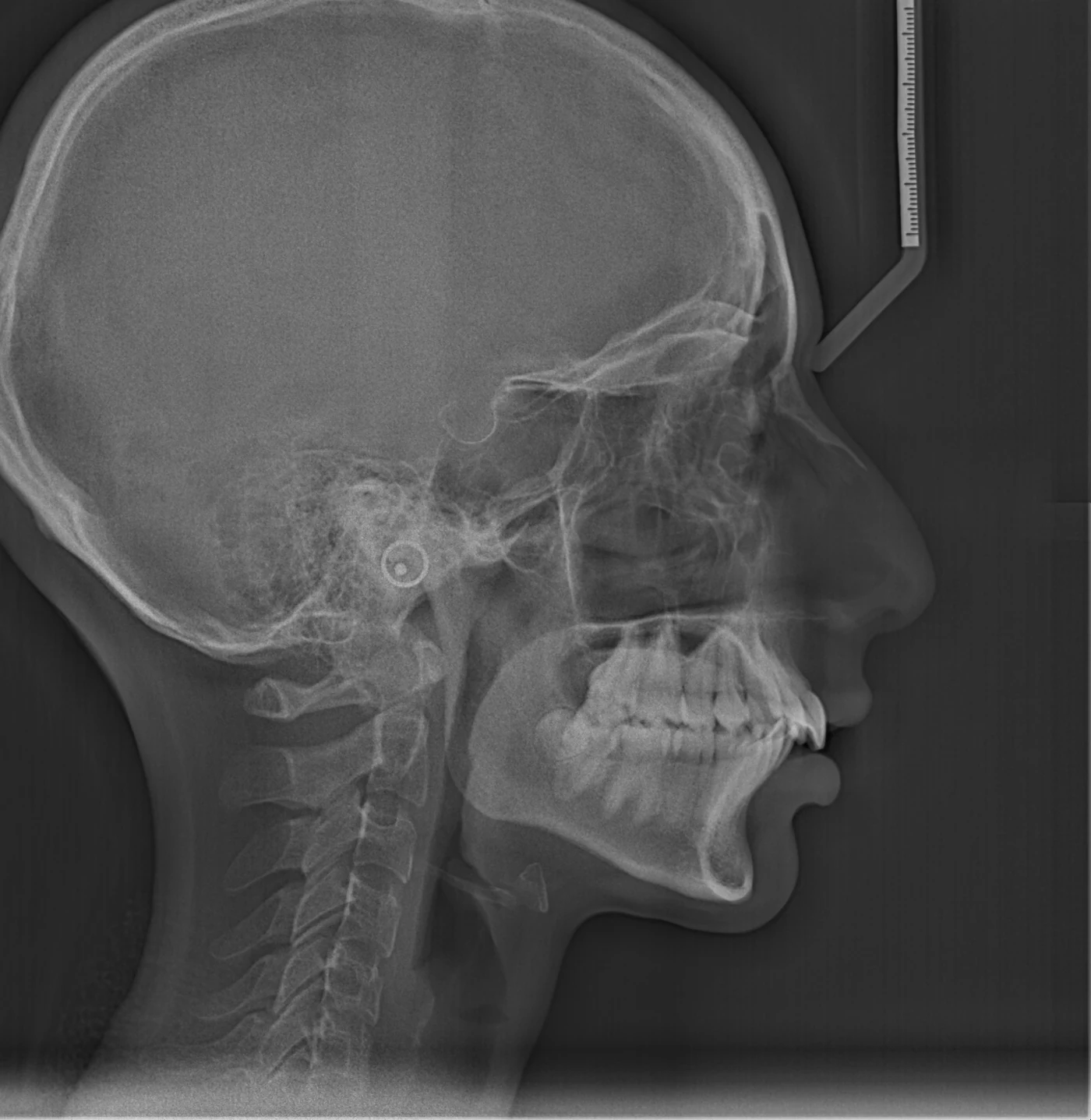 Lateral cephalogram with SmileVision's landmark tracing