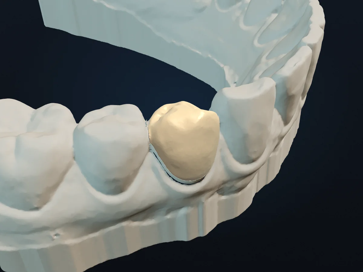 Temporary crown designed by Novel Crown, seated on a prepared lower premolar on an intra-oral scan