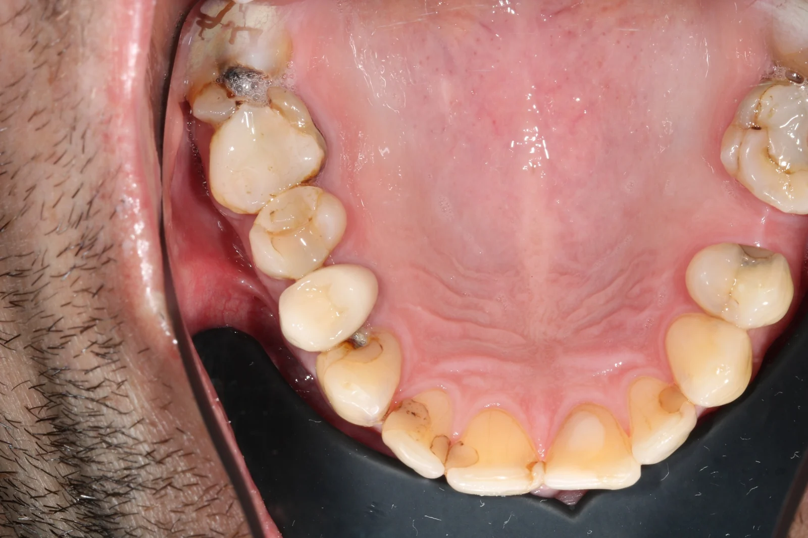 Upper occlusal intra-oral photo with SmileVision's findings outlined