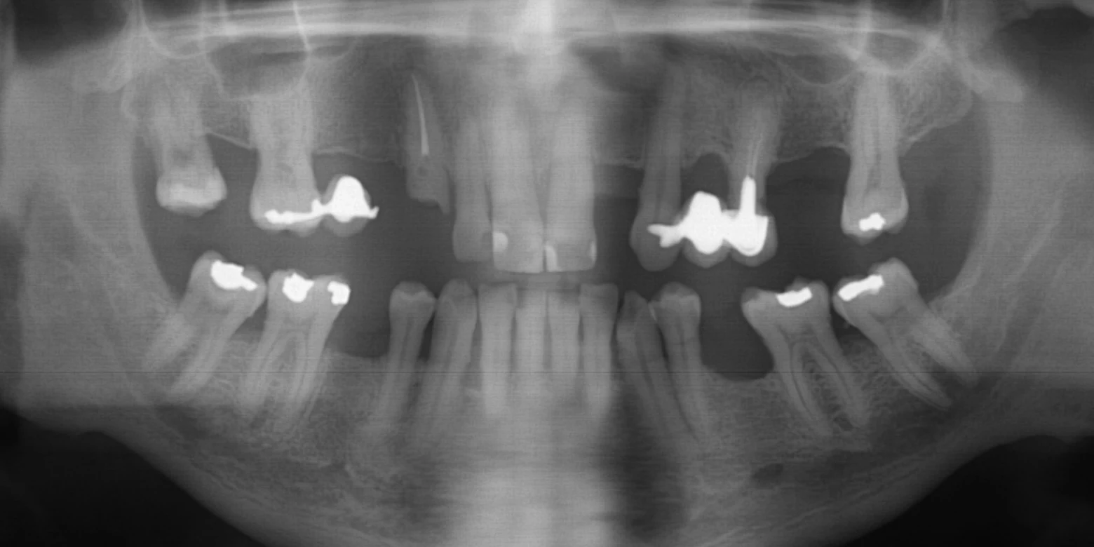 Panoramic X-ray with SmileVision's tooth numbers and findings drawn on top